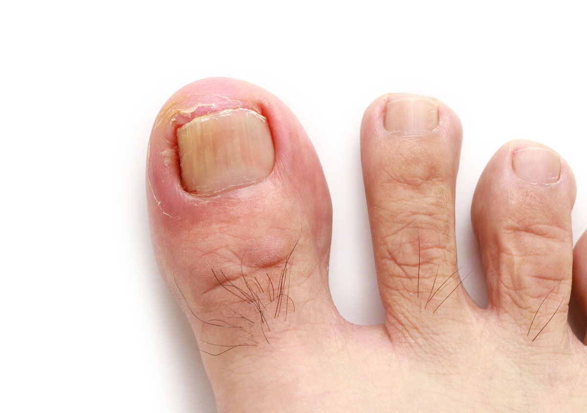 Pain in the Big Toe Joint