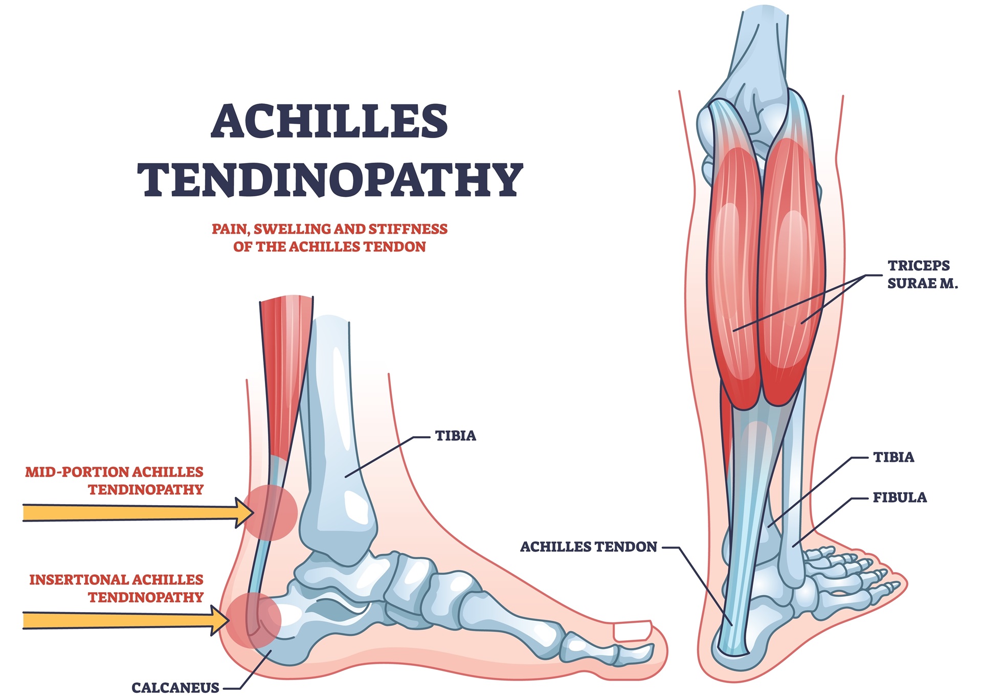 Achilles,Tendinopathy,As,Injury,To,Tendon,In,Heel,Outline,Diagram.