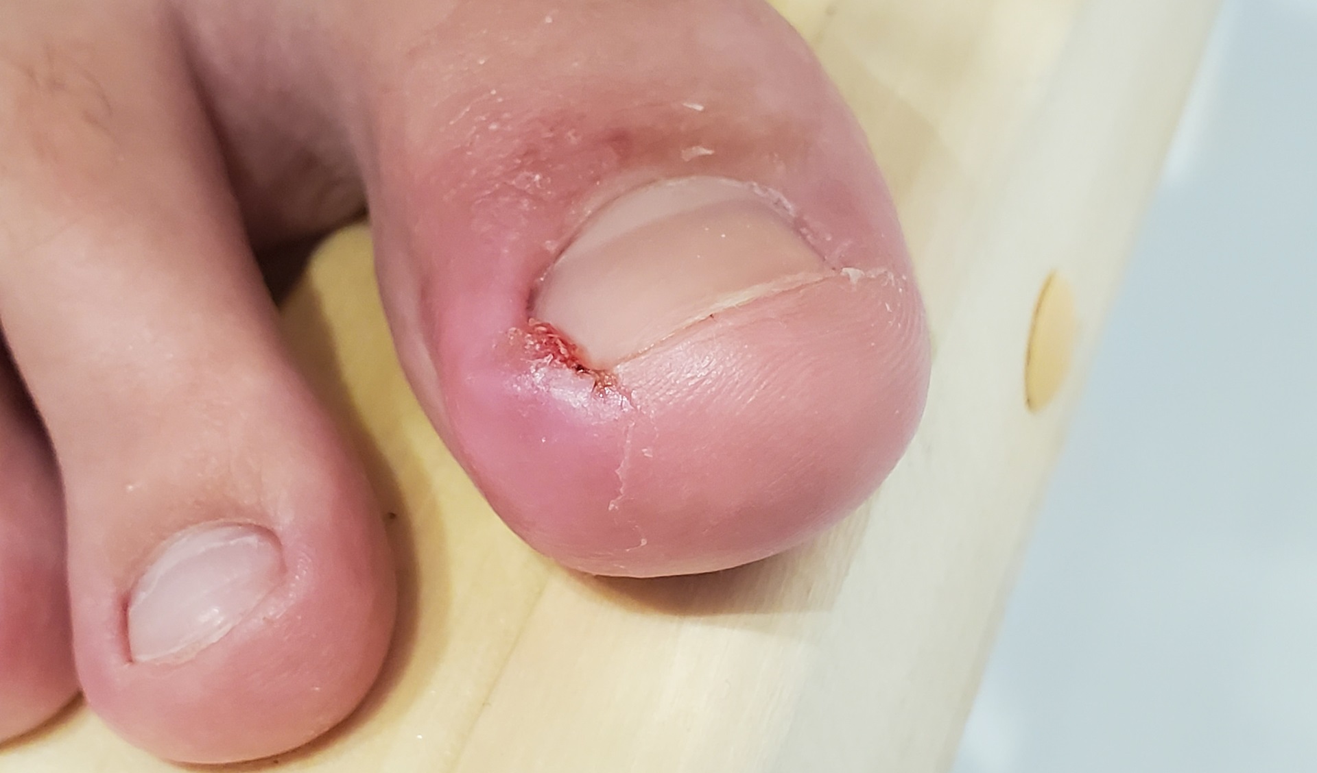 Close-up,Of,An,Inflamed,Big,Toe,With,An,Ingrown,Nail