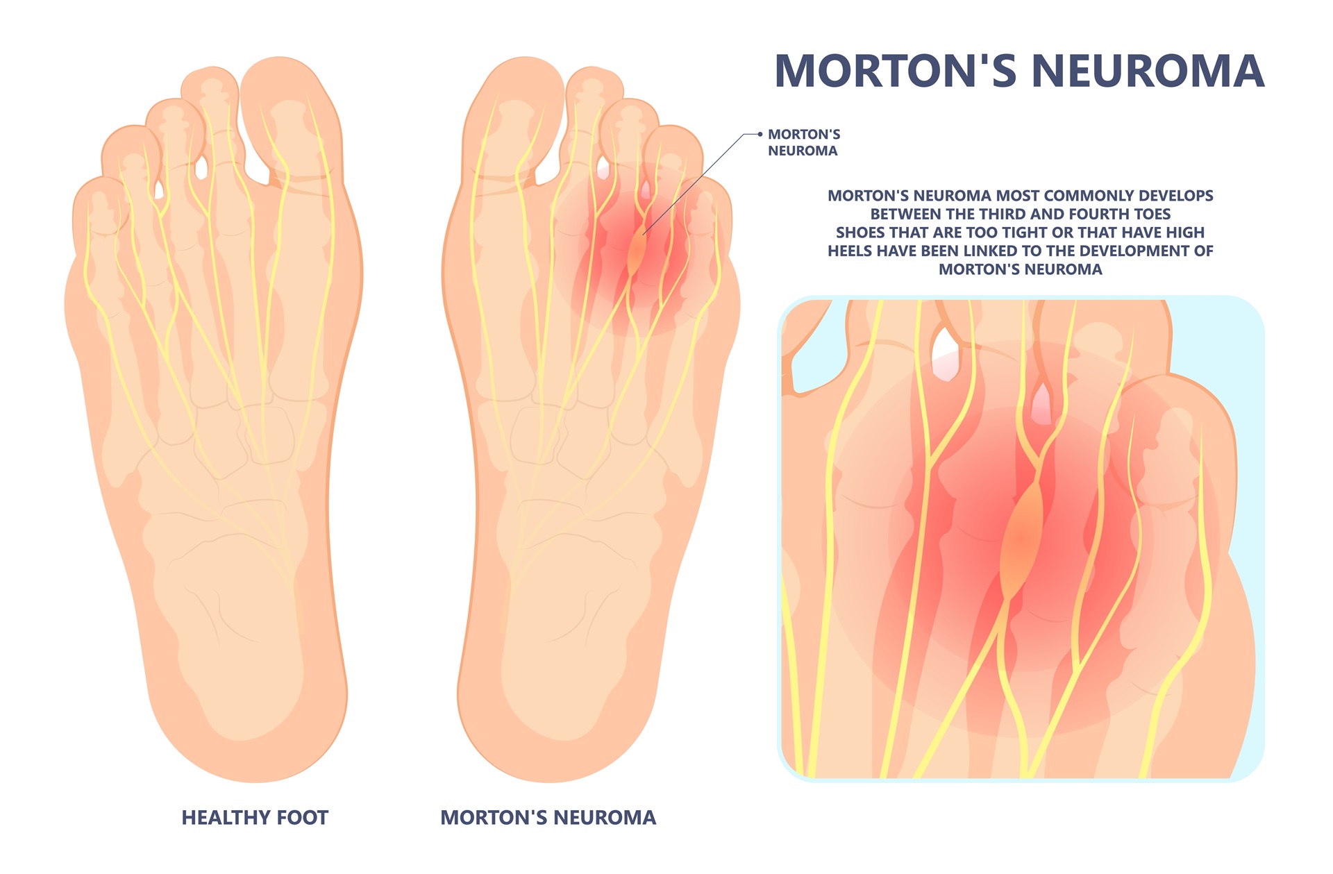 Morton's,Neuroma,Pain,Foot,Ball,Toe,Shoe,Tissue,Nerve,High